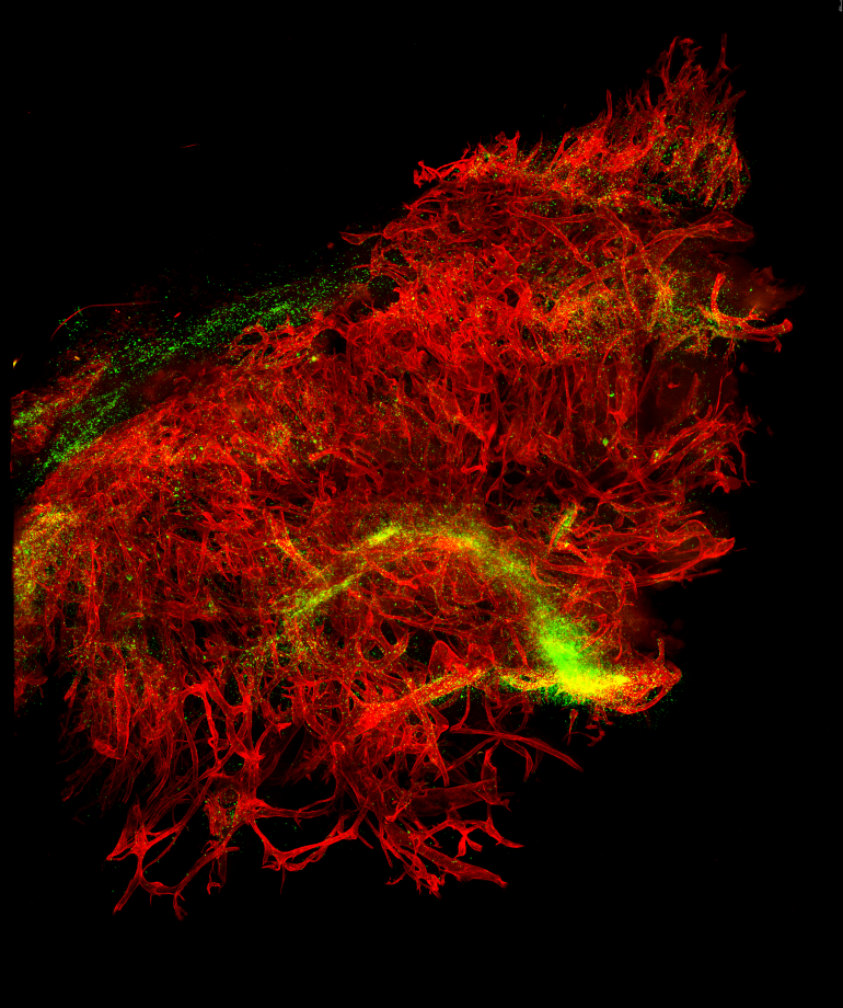 Travelling Through the Blood Vessel Network of a Tumour